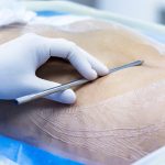 Benefits of Minimally Invasive Spine Procedures